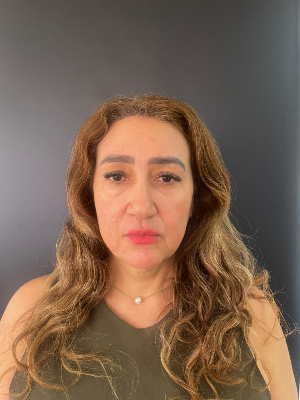Antes: Harmonização Facial