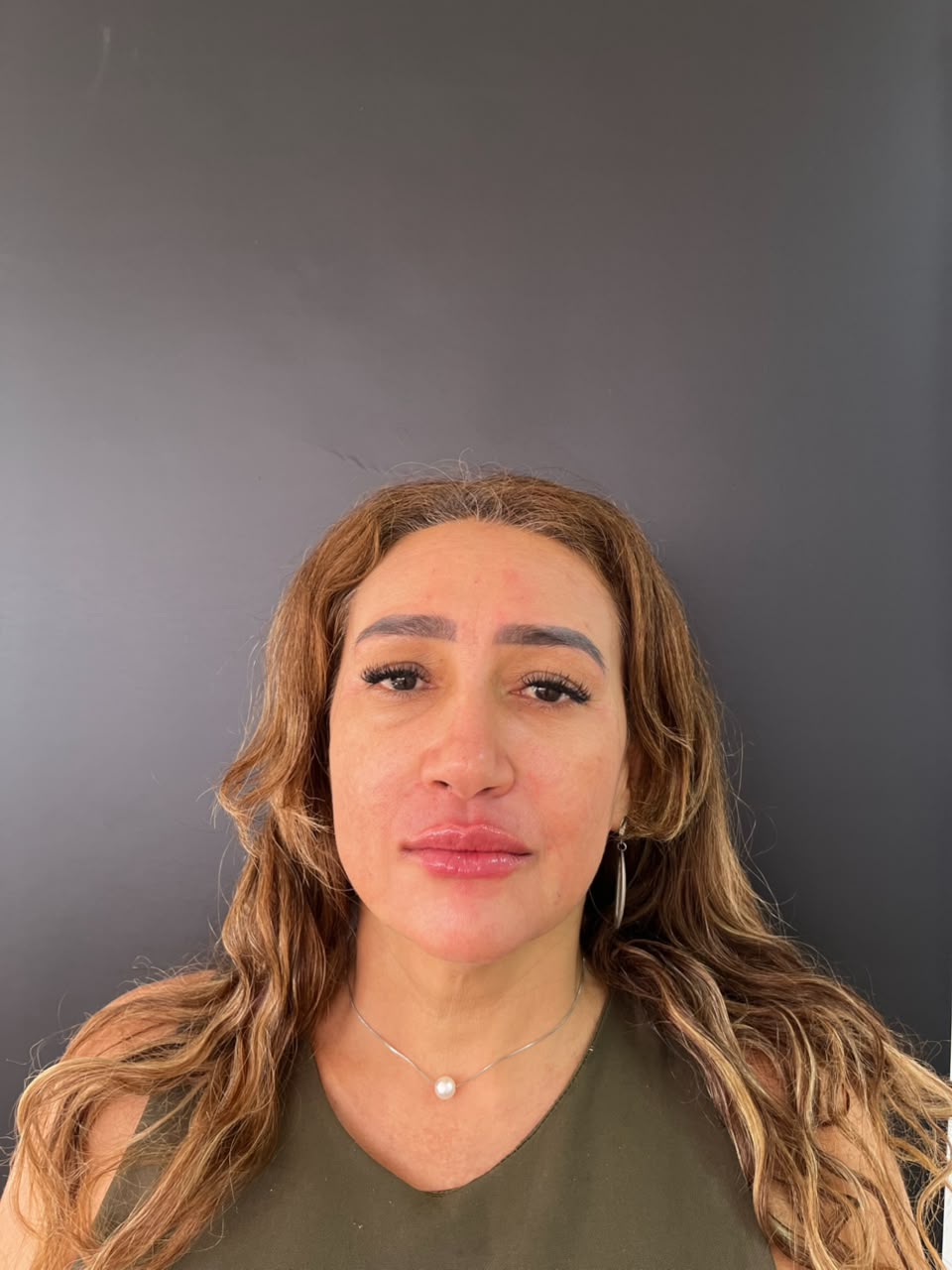 Depois: Harmonização Facial