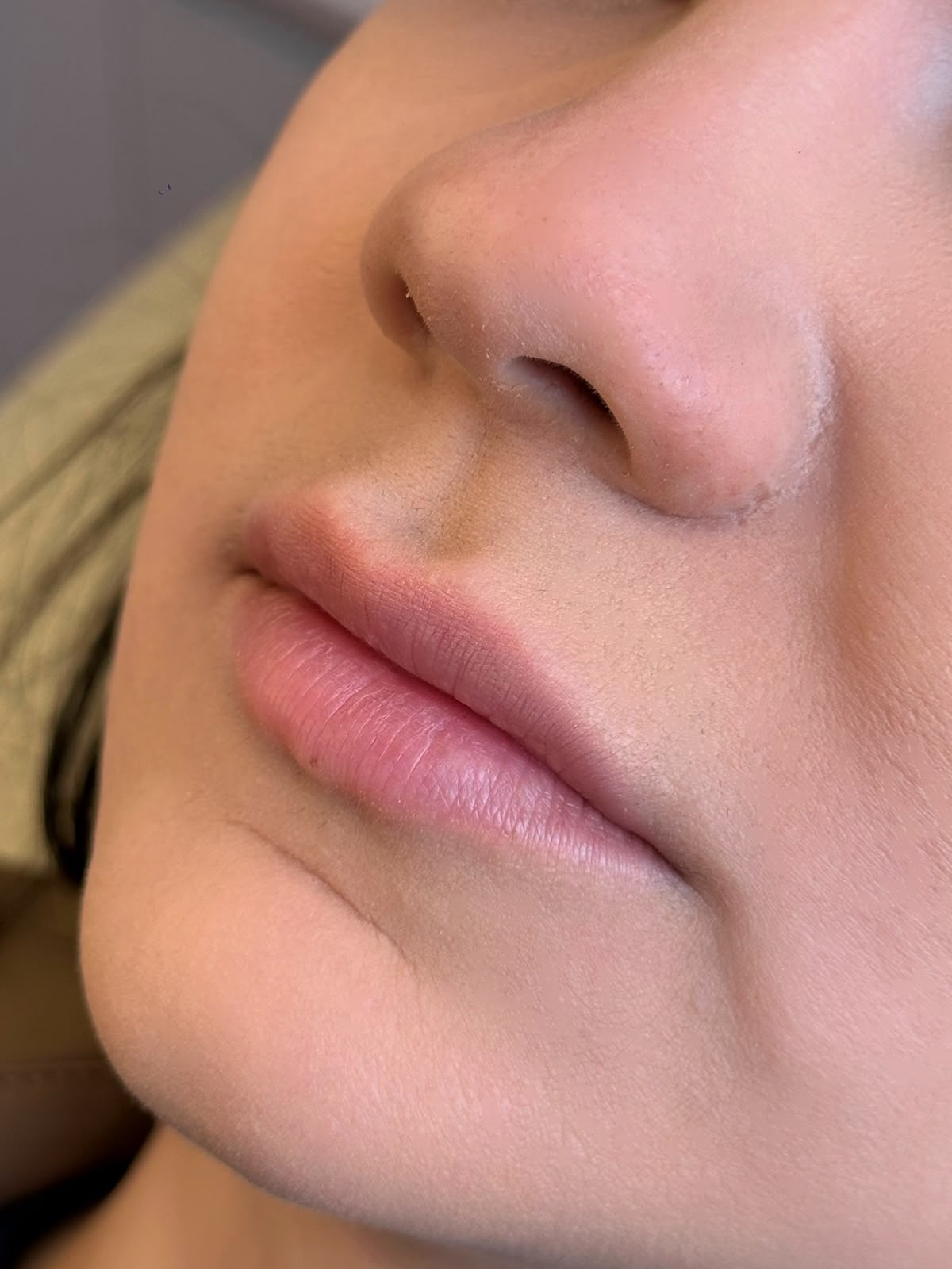 Antes: Preenchimento Labial