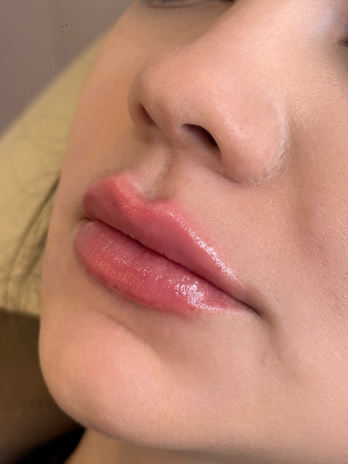 Depois: Preenchimento Labial