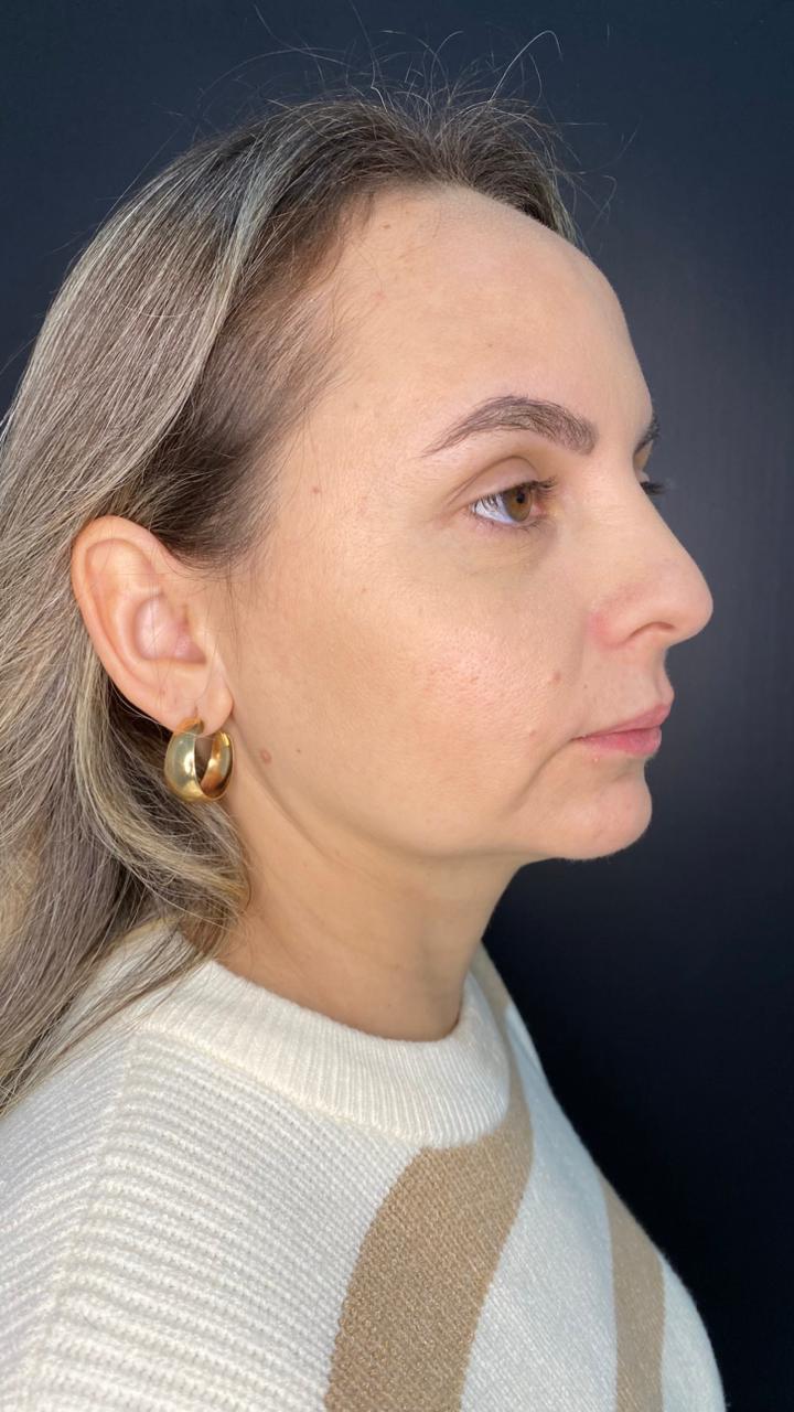 Antes: Harmonização Facial