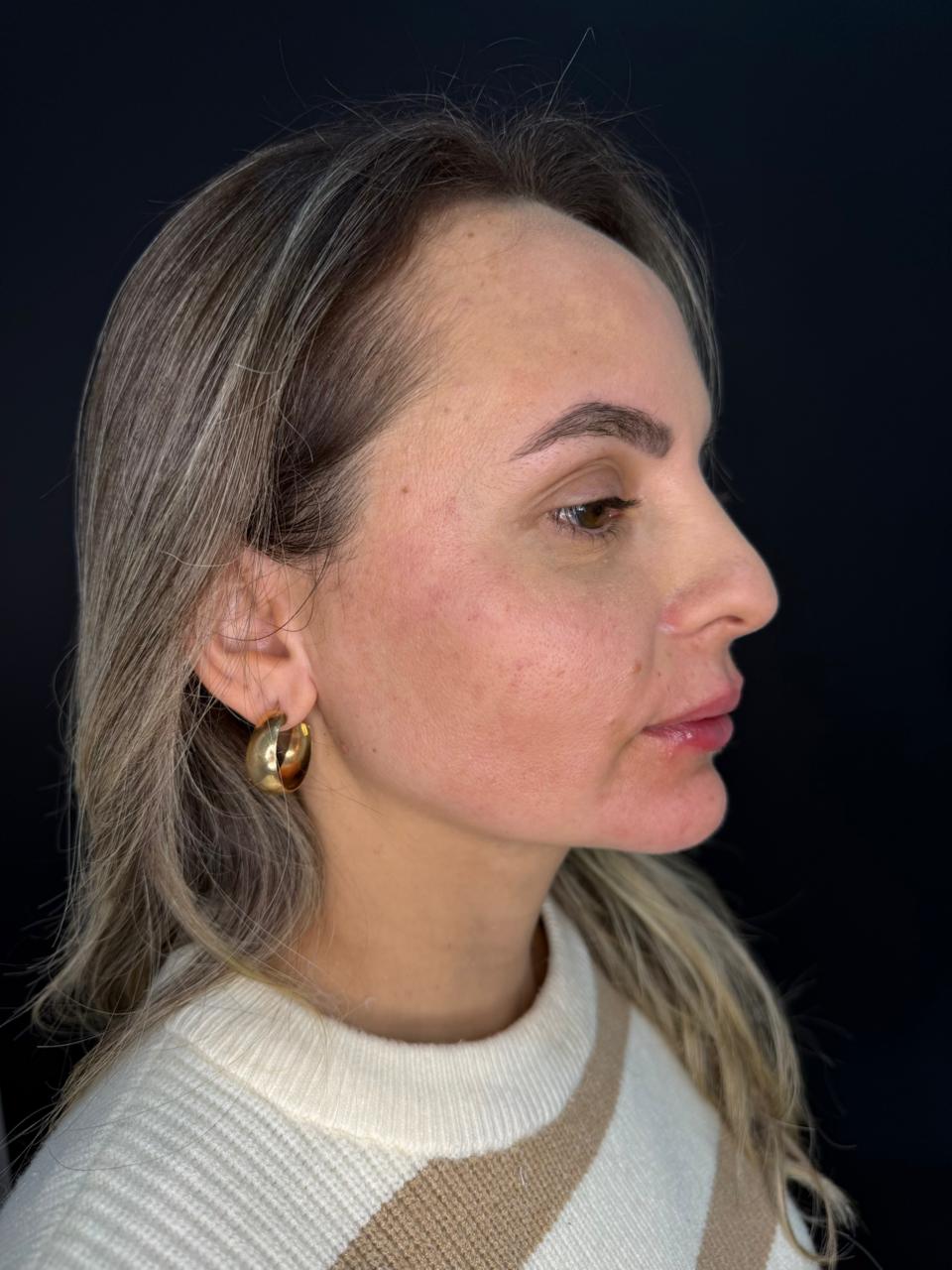 Depois: Harmonização Facial