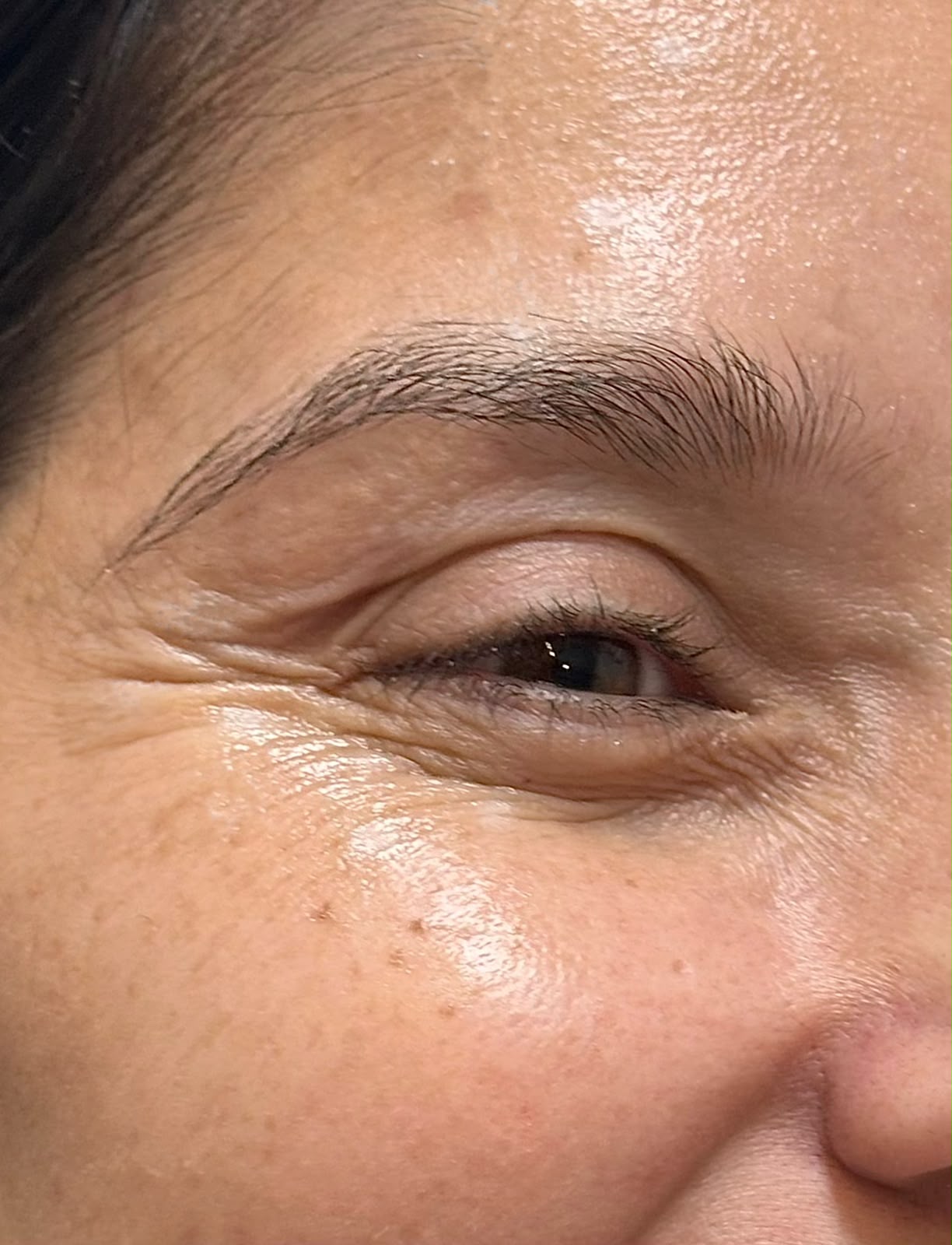 Antes: Rejuvenescimento de Pele