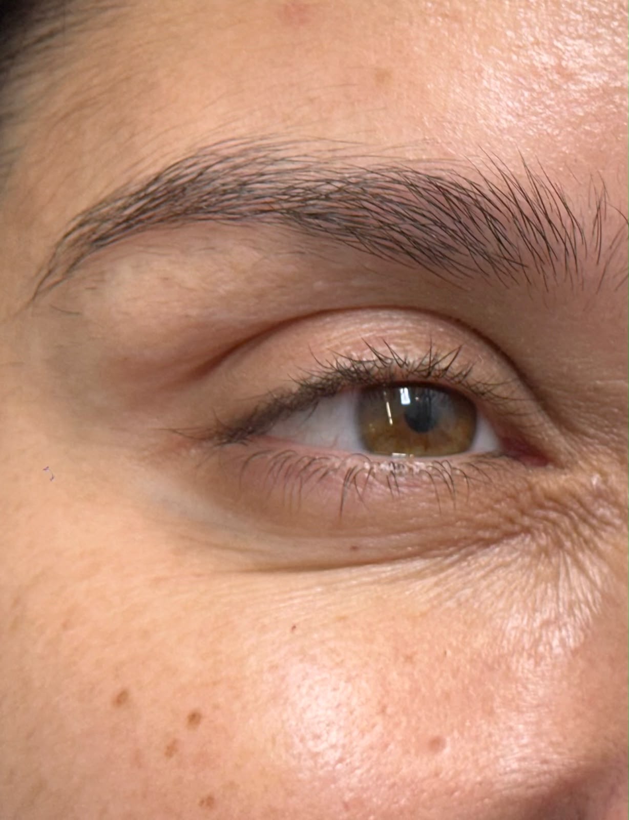 Depois: Rejuvenescimento de Pele
