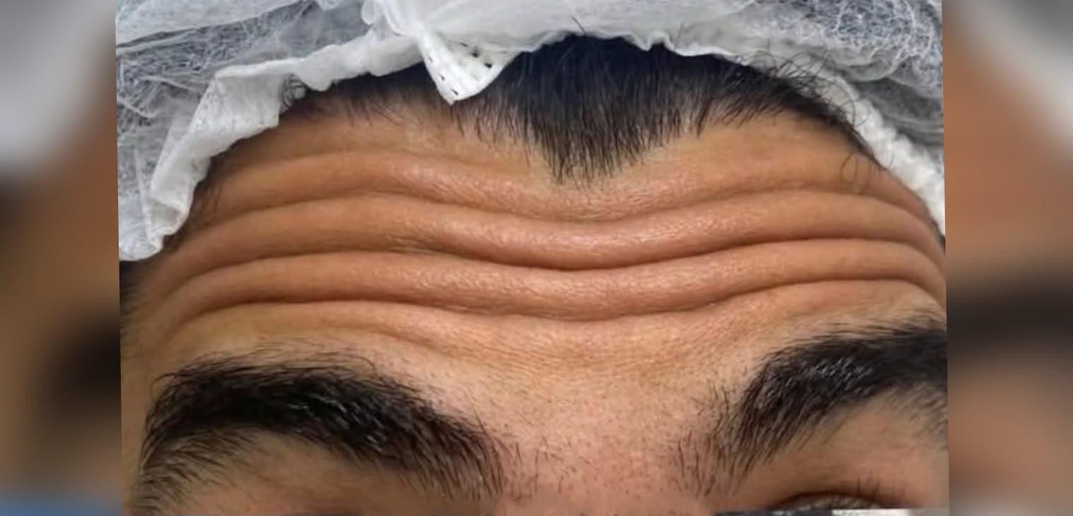 Antes: Toxina Botulínica