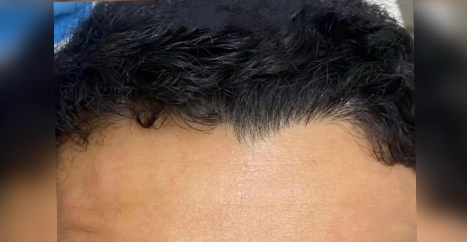 Depois: Toxina Botulínica